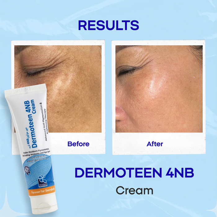 Dermoteen 4NB Cream